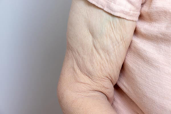 Post Weight Loss Surgery